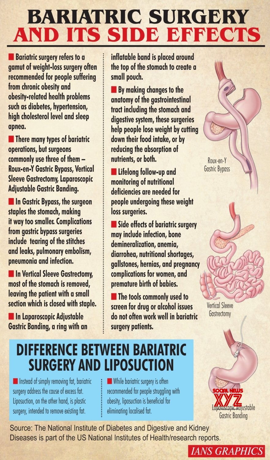 Infographics Bariatric Surgery And Its Side Effects Gallery Social News XYZ